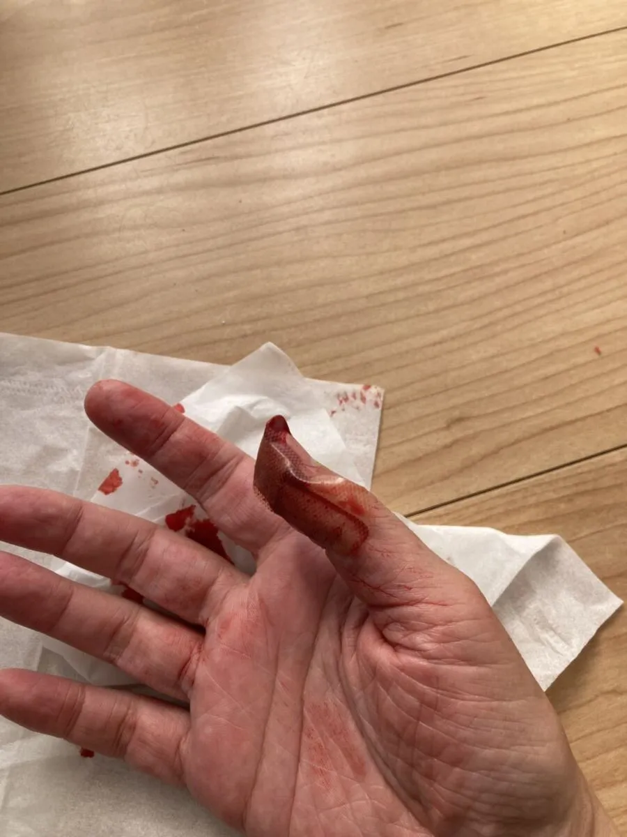 「写真の説明」血が出てる手の写真。痛い痛い